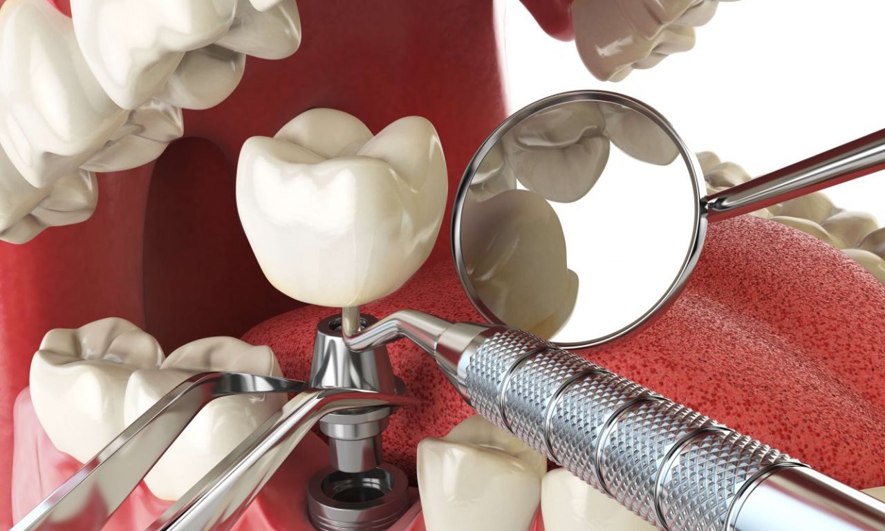 implantaciya-zubov-new-metod